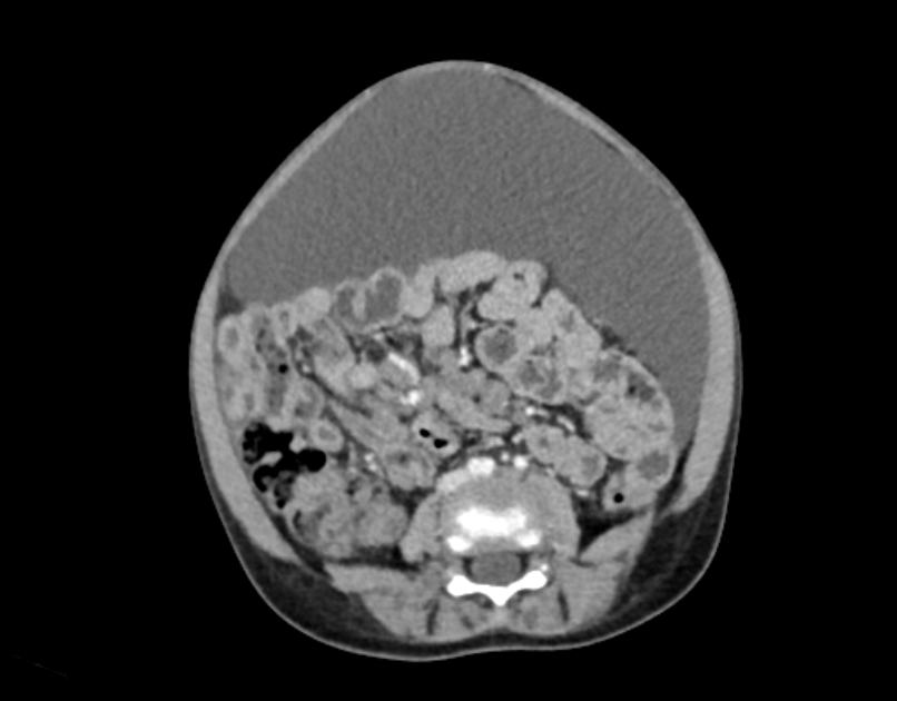 Abdominal premesenteric cystic lymphangioma (Radiopaedia 82995-97350 Axial C+ portal venous phase 37).jpg