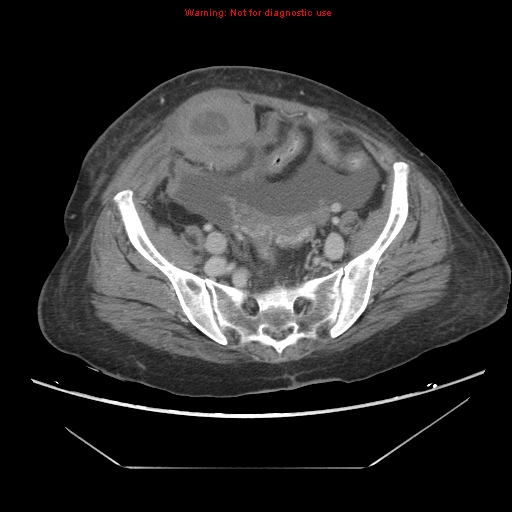 File:Abdominal wall hematoma (Radiopaedia 9427-10112 Axial C+ portal venous phase 84).jpg
