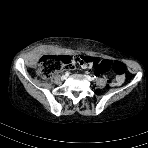 Abdominal wall hematoma with active bleeding (Radiopaedia 83915-99117 Axial C+ portal venous phase 87).jpg
