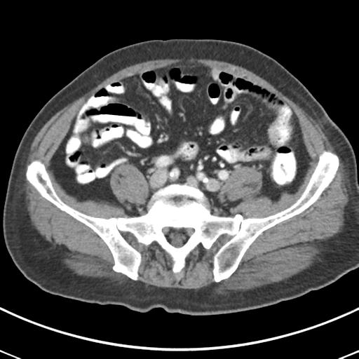 Abdominal wall metastasis from colorectal carcinoma (Radiopaedia 31016-31717 Axial C+ portal venous phase 53).jpg
