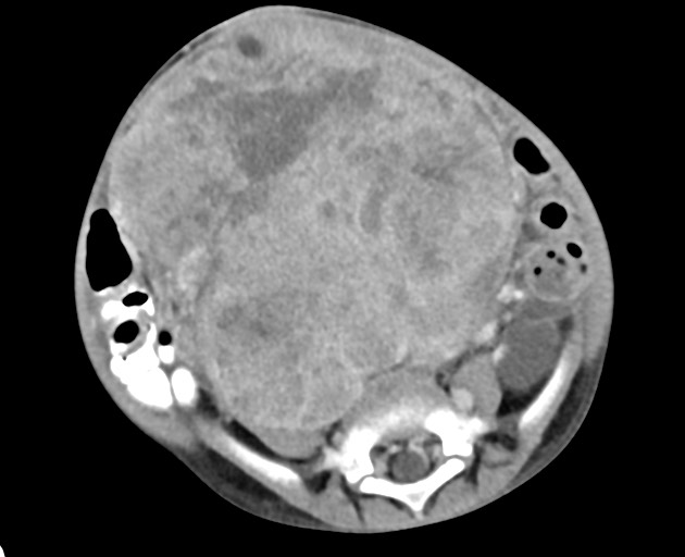 Abdominopelvic rhabdomyosarcoma (Radiopaedia 78356-90984 Axial C+ portal venous phase 114).jpg