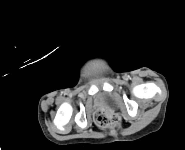 Abdominopelvic rhabdomyosarcoma (Radiopaedia 78356-90984 Axial C+ portal venous phase 153).jpg