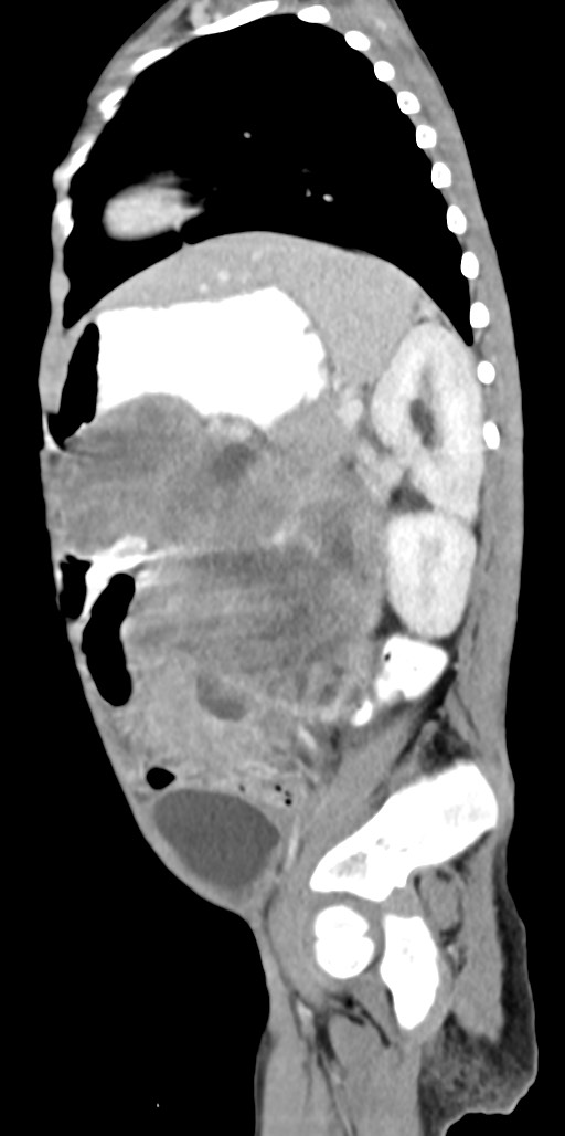 Abdominopelvic rhabdomyosarcoma (Radiopaedia 78356-90984 Sagittal C+ portal venous phase 30).jpg