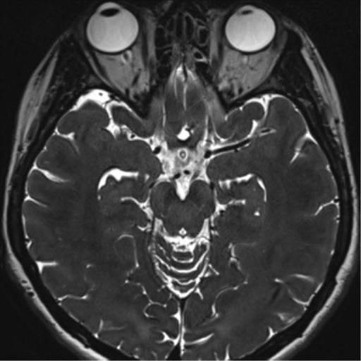Abducens nerve palsy (Radiopaedia 51069-56648 Axial T2 fat sat 64).png