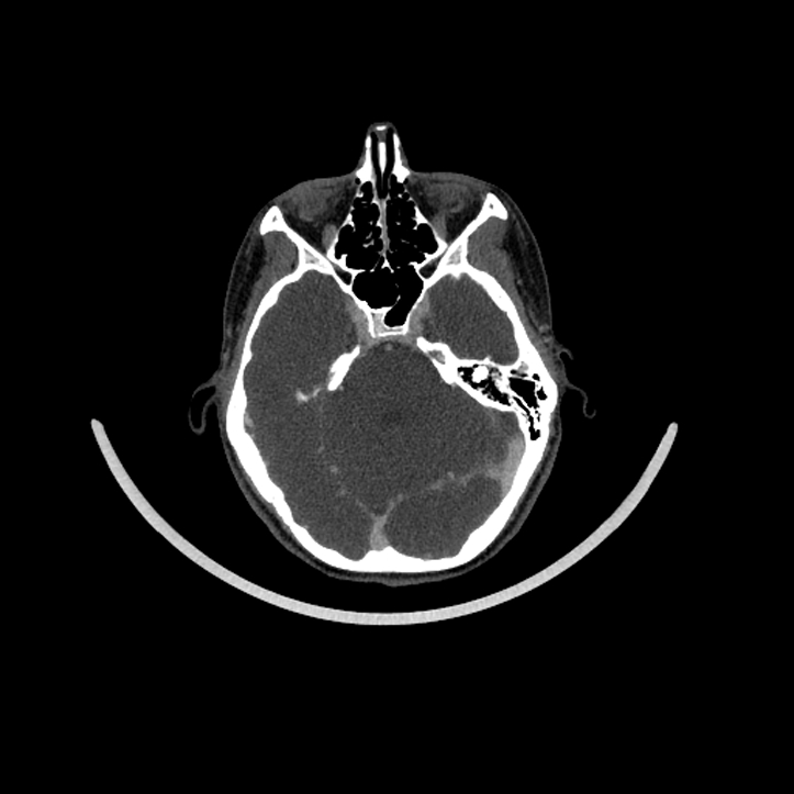 Aberrant right internal carotid artery (Radiopaedia 65191-74197 Axial C+ arterial phase 15).jpg