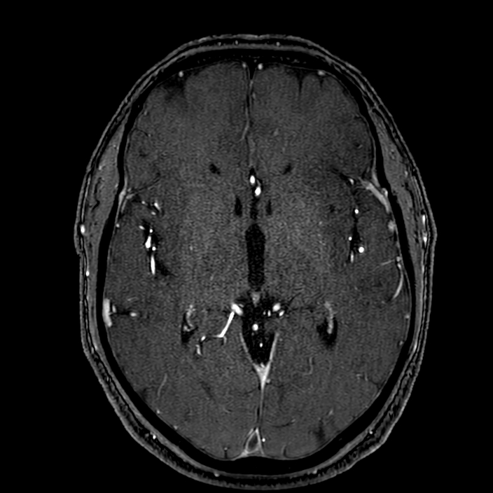 Accessory middle cerebral artery (Radiopaedia 73114-83828 Axial MRA 98).jpg