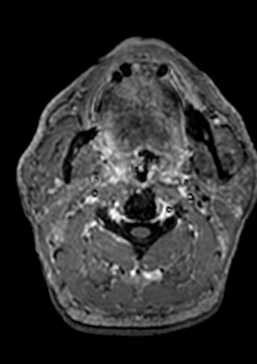 File:Accessory middle cerebral artery (Radiopaedia 73114-83828 Axial T1 C+ 265).jpg