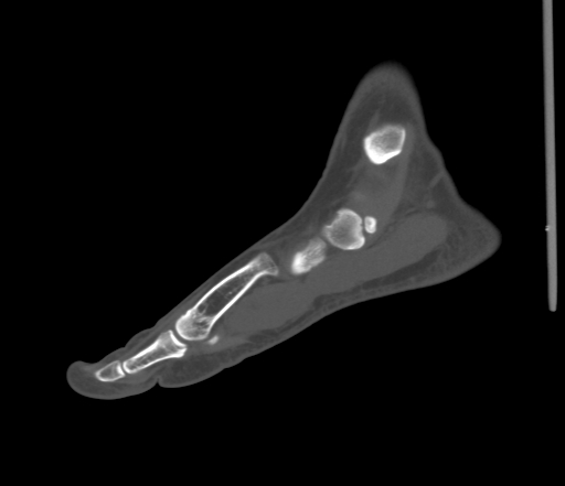 File:Accessory navicular bone (Radiopaedia 54999-61314 Sagittal non-contrast 29).jpg