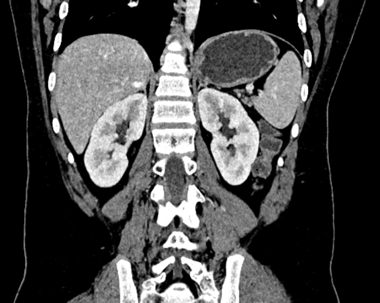 Accessory right inferior hepatic vein (Radiopaedia 75207-86305 Coronal C+ portal venous phase 52).jpg