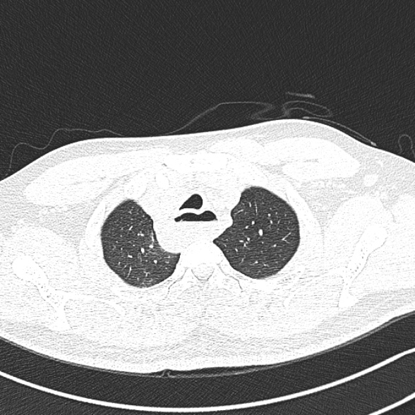 Achalasia with aspiration (Radiopaedia 55413-61845 Axial lung window 9).jpg