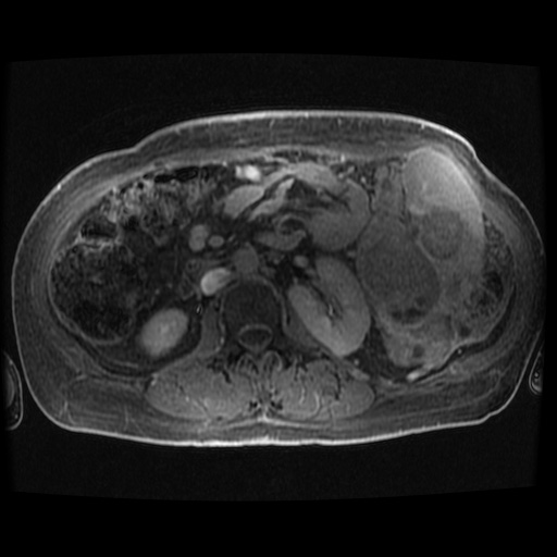Acinar cell carcinoma of the pancreas (Radiopaedia 75442-86668 Axial late phase (~30 mins) 25).jpg