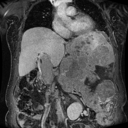 Acinar cell carcinoma of the pancreas (Radiopaedia 75442-86668 Coronal T1 C+ fat sat 112).jpg