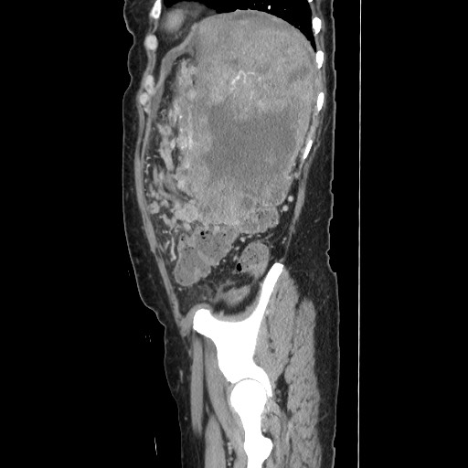 Acinar cell carcinoma of the pancreas (Radiopaedia 75442-86669 Sagittal C+ portal venous phase 151).jpg