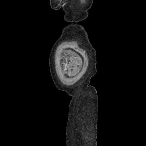 Acinar cell carcinoma of the pancreas (Radiopaedia 75442-86669 Sagittal C+ portal venous phase 184).jpg