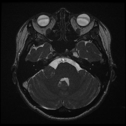Acoustic neuroma (Radiopaedia 34049-35283 Axial 60).png