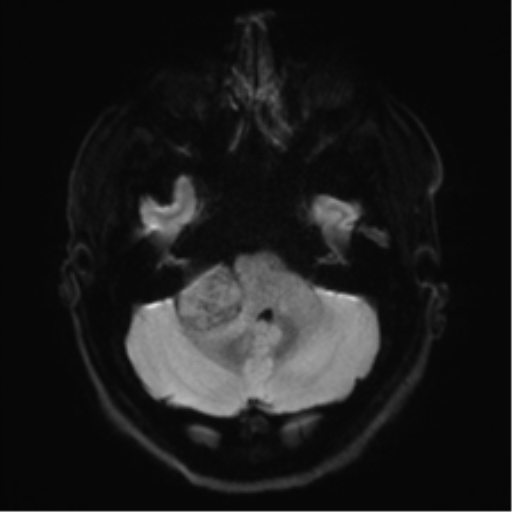 Acoustic schwannoma (Radiopaedia 50846-56358 Axial DWI 34).png