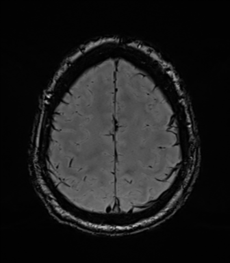 File:Acoustic schwannoma (Radiopaedia 50846-56358 Axial SWI 77).png