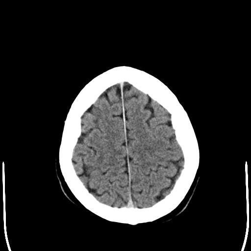 File:Acoustic schwannoma - cystic (Radiopaedia 29487-29980 AXIAL THICK non-contrast 23).jpg