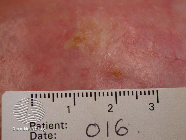 Actinic Keratoses affecting the face (DermNet NZ lesions-ak-face-541).jpg