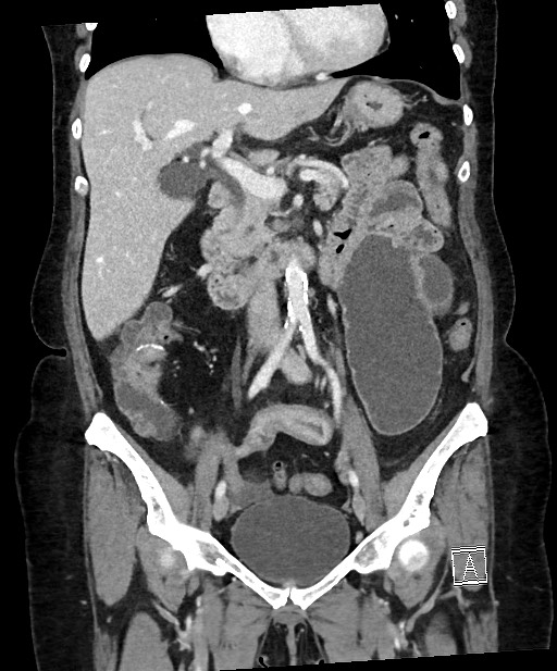 Active Crohn disease (Radiopaedia 59394-66750 Coronal C+ portal venous phase 35).jpg