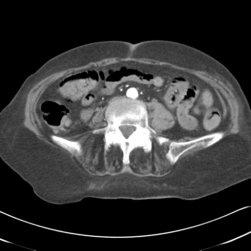 File:Active bleeding from duodenal ulcer with embolization (Radiopaedia 34216-35481 Axial C+ arterial phase 38).png