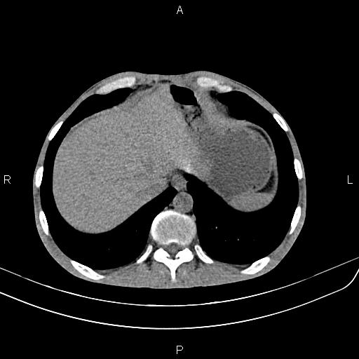 File:Active crohn disease (Radiopaedia 87133-103397 Axial non-contrast 12).jpg