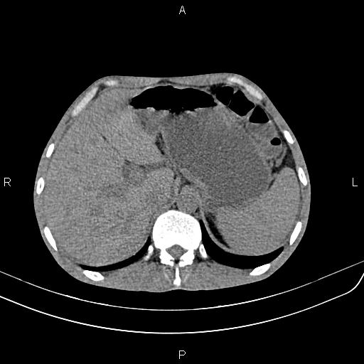 Active crohn disease (Radiopaedia 87133-103397 Axial non-contrast 21).jpg