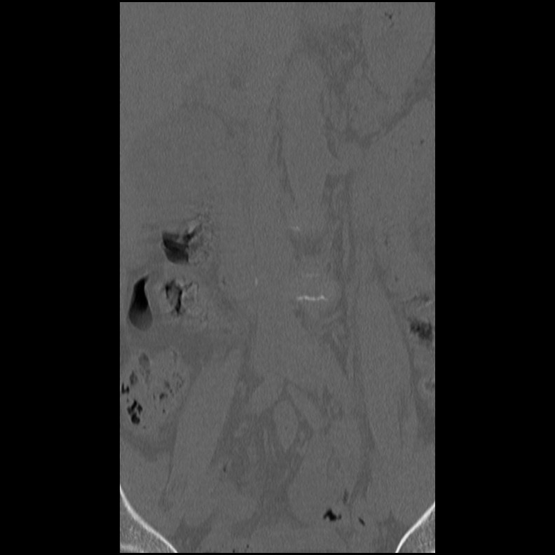 Acute Schmorl's node (Radiopaedia 83276-102365 Coronal bone window 11).jpg
