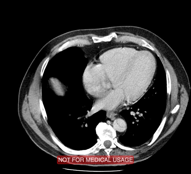 Acute aortic dissection - Stanford type A (Radiopaedia 40661-43285 Axial C+ portal venous phase 38).jpg