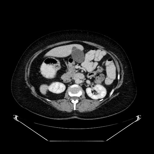 File:Acute appendicitis, heterotaxy syndrome (Radiopaedia 66884-76202 Axial 57).jpg