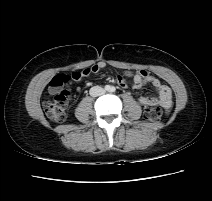 Acute appendicitis (Radiopaedia 22892-22918 Axial C+ portal venous phase 46).png
