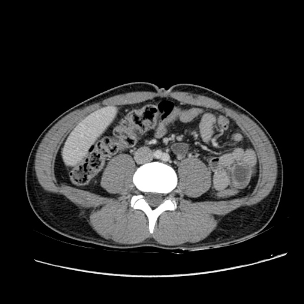Acute appendicitis (Radiopaedia 27049-27227 Axial C+ portal venous phase 42).jpg