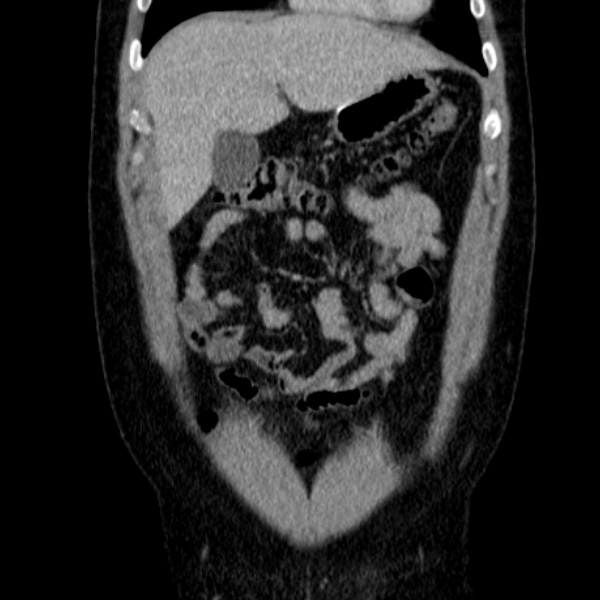 Acute appendicitis (Radiopaedia 38255-40270 Coronal C+ portal venous phase 24).jpg