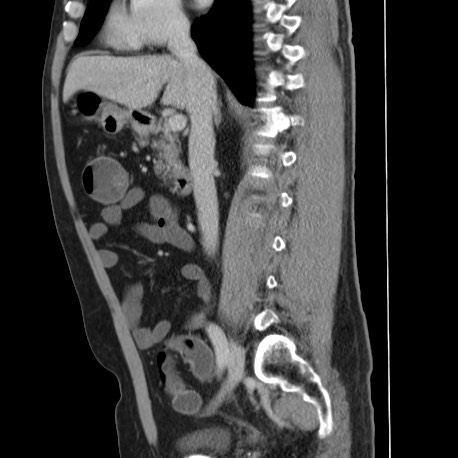 File:Acute appendicitis (Radiopaedia 66513-75790 Sagittal C+ portal venous phase 68).jpg