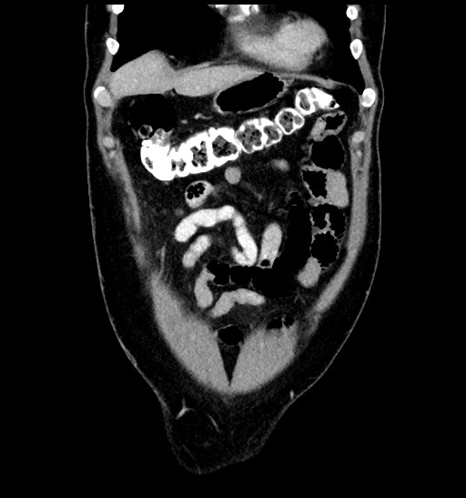Acute appendicitis (Radiopaedia 77016-88960 Coronal C+ portal venous phase 27).jpg