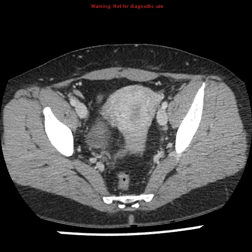 File:Acute appendicitis (Radiopaedia 7966-8812 C+ portal venous phase 47).jpg