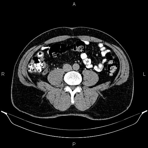 File:Acute appendicitis (Radiopaedia 84780-100240 Axial C+ delayed 65).jpg