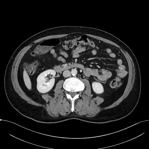 Acute appendicitis - large appendicoliths (Radiopaedia 61805-69820 Axial C+ portal venous phase 63).jpg