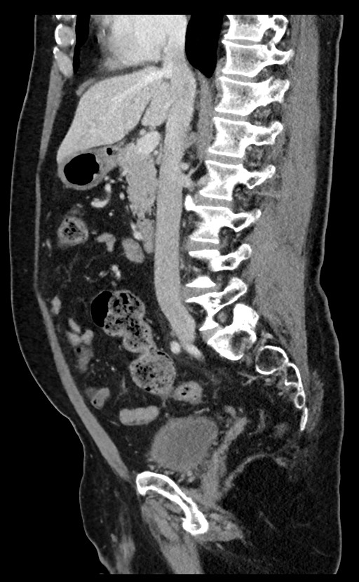 Acute appendicitis - large appendicoliths (Radiopaedia 61805-69820 Sagittal C+ portal venous phase 65).jpg