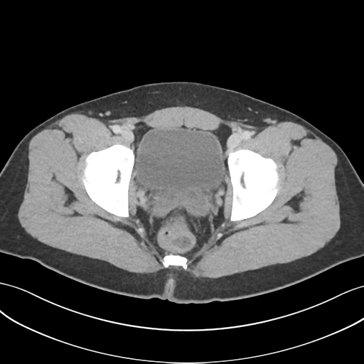File:Acute appendicitis with appendicoliths (Radiopaedia 50186-55532 Axial C+ portal venous phase 77).png