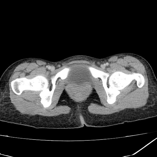 Acute bilateral pyelonephritis (Radiopaedia 74153-84969 Axial C+ portal venous phase 50).jpg