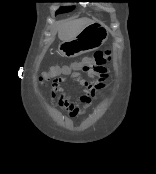 Acute bleed from gastric fundus biopsy site (Radiopaedia 35201-36737 Coronal C+ arterial phase 12).png