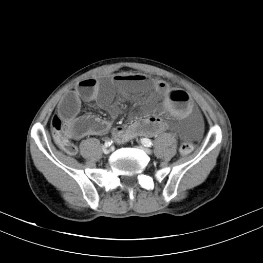 Acute bowel ischemia (Radiopaedia 87695-104114 Axial C+ portal venous phase 60).jpg