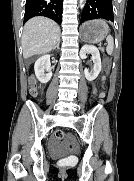 Acute bowel ischemia (Radiopaedia 87695-104114 Coronal C+ portal venous phase 263).jpg