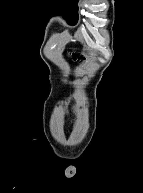 Acute bowel ischemia (Radiopaedia 87695-104114 Coronal C+ portal venous phase 70).jpg