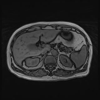 File:Acute cholecystitis (Radiopaedia 72392-82923 Axial T1 out-of-phase 46).jpg