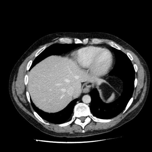 File:Acute cholecystitis and incidental left sided IVC (Radiopaedia 49352-54459 Axial C+ portal venous phase 27).jpg