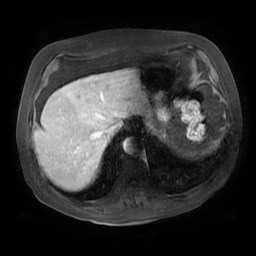 File:Acute cholecystitis complicated by pylephlebitis (Radiopaedia 65782-74915 Axial arterioportal phase T1 C+ fat sat 18).jpg