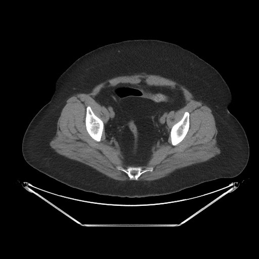 File:Acute cholecystitis with tensile fundus sign (Radiopaedia 71394-81723 Axial non-contrast 101).jpg