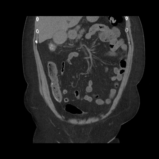 File:Acute cholecystitis with tensile fundus sign (Radiopaedia 71394-81723 Coronal non-contrast 51).jpg